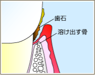 軽度歯周炎