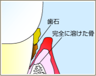 重度歯周病