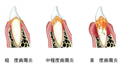 歯周病の進行